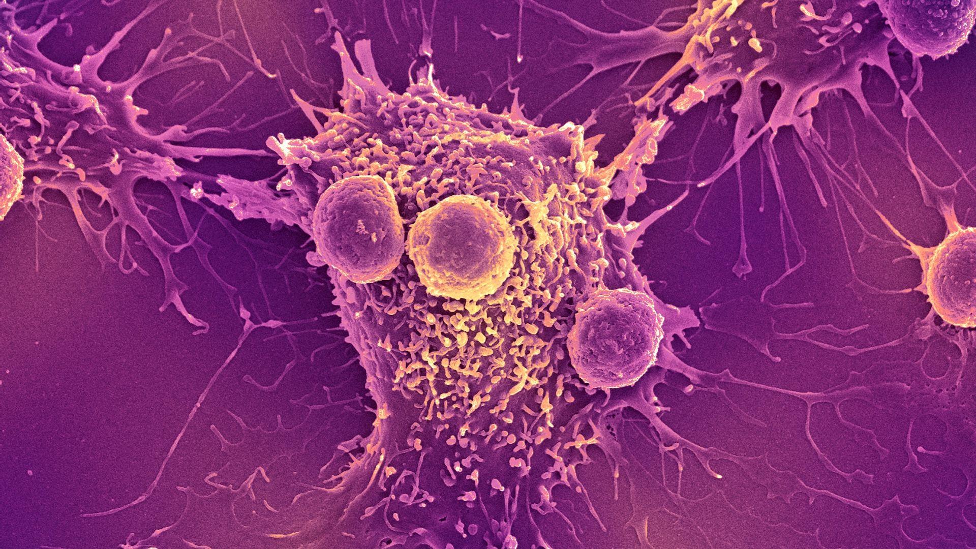 My COVID-19 vaccine can trigger the immune system to recognize and kill cancer, study finds |Live Sc...