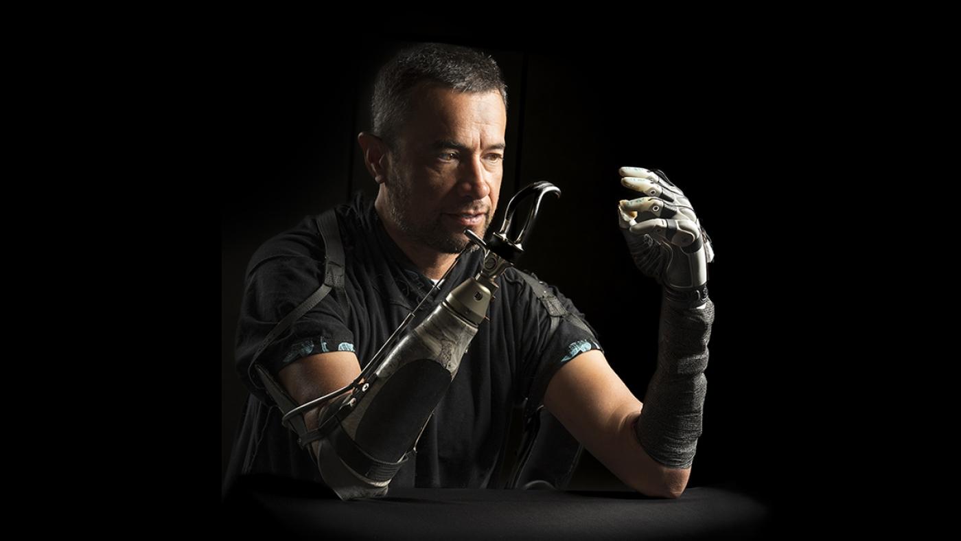 Amputees are often disconnected from bionic arms.AI Can Bridge the GAP: HR - Health News: